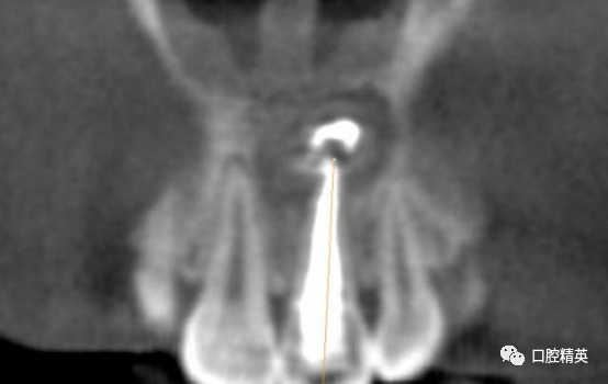 前牙根尖囊肿根尖切除手术