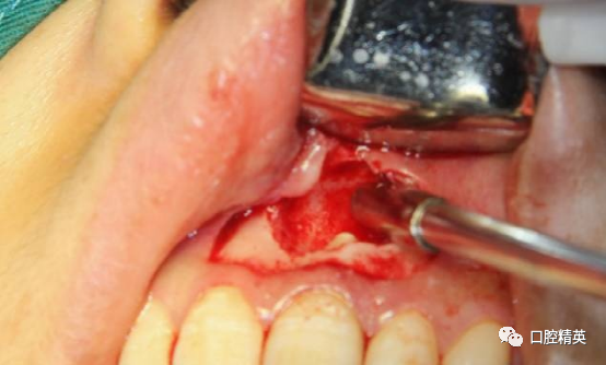 前牙根尖囊肿根尖切除手术