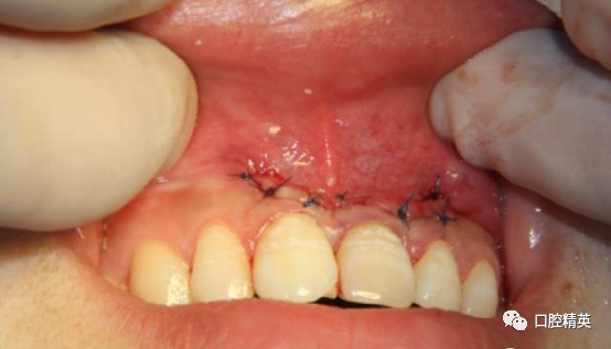 前牙根尖囊肿根尖切除手术