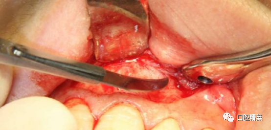前牙根尖囊肿根尖切除手术