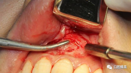 前牙根尖囊肿根尖切除手术