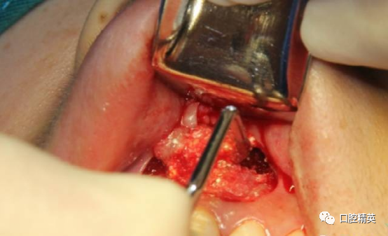 前牙根尖囊肿根尖切除手术