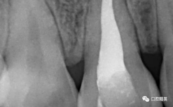 前牙根尖囊肿根尖切除手术