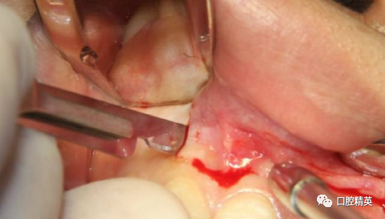 前牙根尖囊肿根尖切除手术