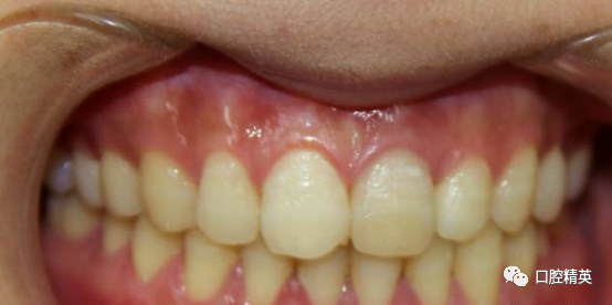 前牙根尖囊肿根尖切除手术