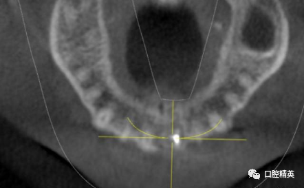 前牙根尖囊肿根尖切除手术