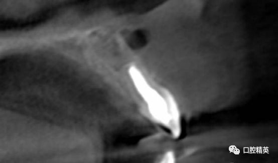 前牙根尖囊肿根尖切除手术