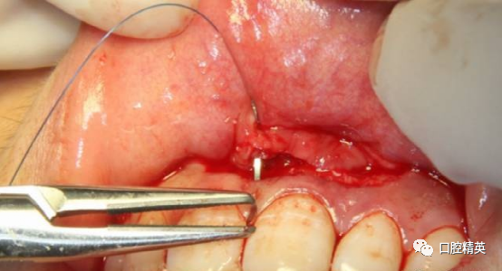 前牙根尖囊肿根尖切除手术