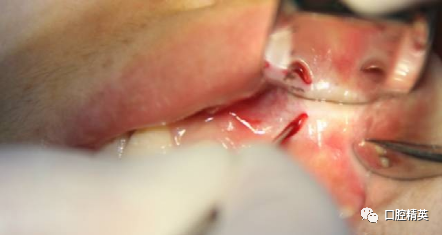 前牙根尖囊肿根尖切除手术