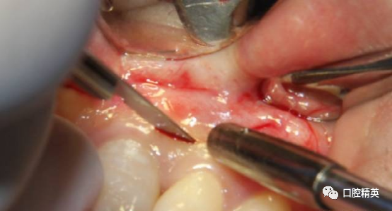 前牙根尖囊肿根尖切除手术