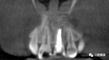 前牙根尖囊肿根尖切除手术
