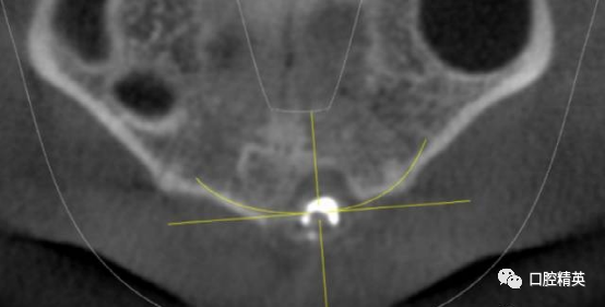 前牙根尖囊肿根尖切除手术