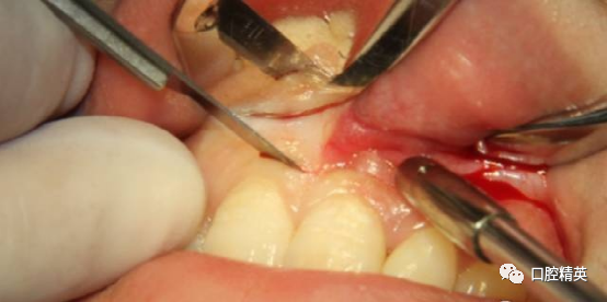 前牙根尖囊肿根尖切除手术