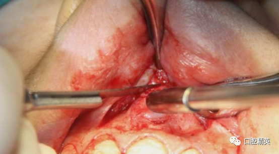 前牙根尖囊肿根尖切除手术