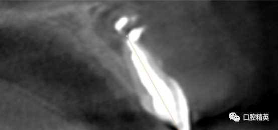 前牙根尖囊肿根尖切除手术