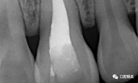 前牙根尖囊肿根尖切除手术