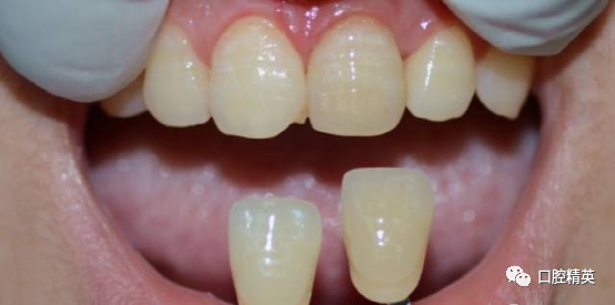 前牙根尖囊肿根尖切除手术