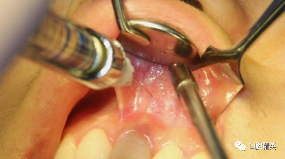 前牙根尖囊肿根尖切除手术