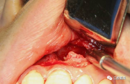 前牙根尖囊肿根尖切除手术