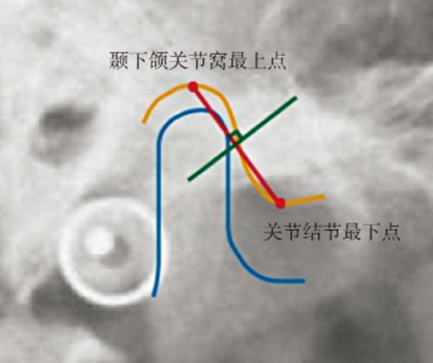 正畸治疗可视化（VTO）操作步骤