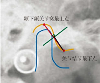 正畸治疗可视化（VTO）操作步骤