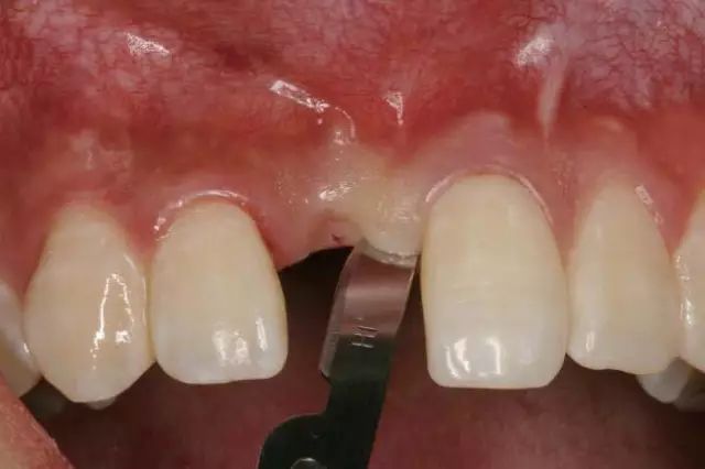 翻瓣手术如何做,看完这篇手术思路更清晰!