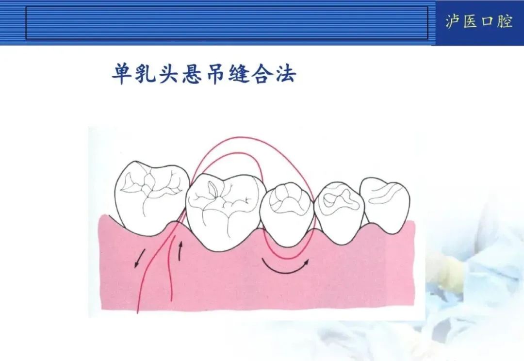 翻瓣手术如何做,看完这篇手术思路更清晰!