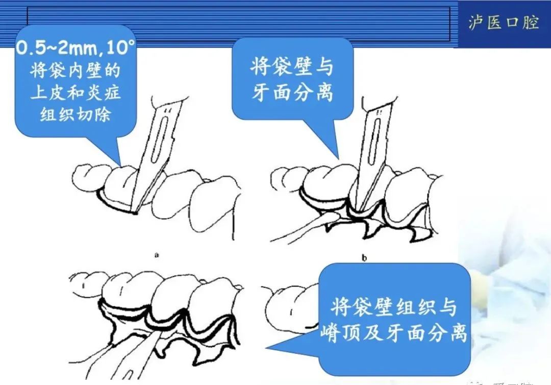 翻瓣手术如何做,看完这篇手术思路更清晰!