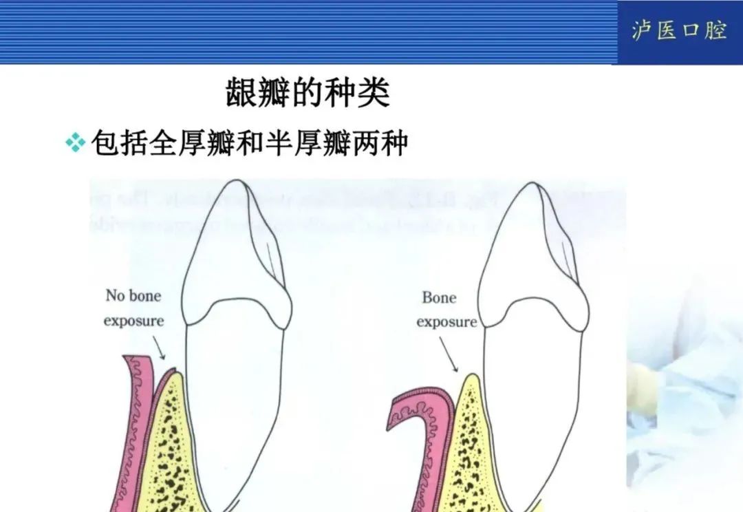 翻瓣手术如何做,看完这篇手术思路更清晰!