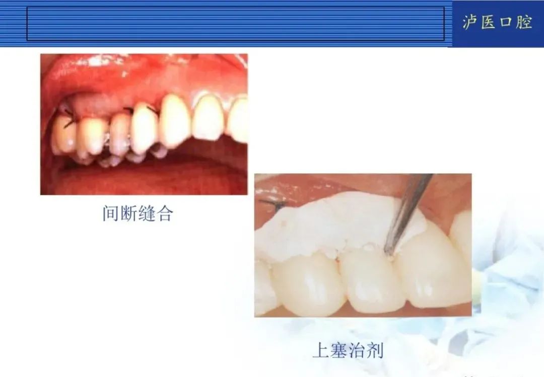 翻瓣手术如何做,看完这篇手术思路更清晰!