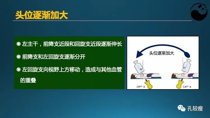 步步为营掌握冠状动脉造影:解剖-体位-安全法则
