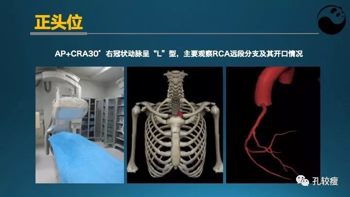 步步为营掌握冠状动脉造影:解剖-体位-安全法则