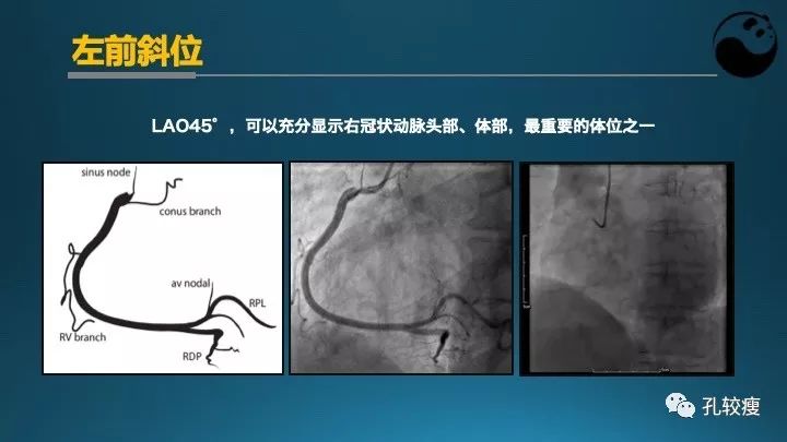 步步为营掌握冠状动脉造影:解剖-体位-安全法则