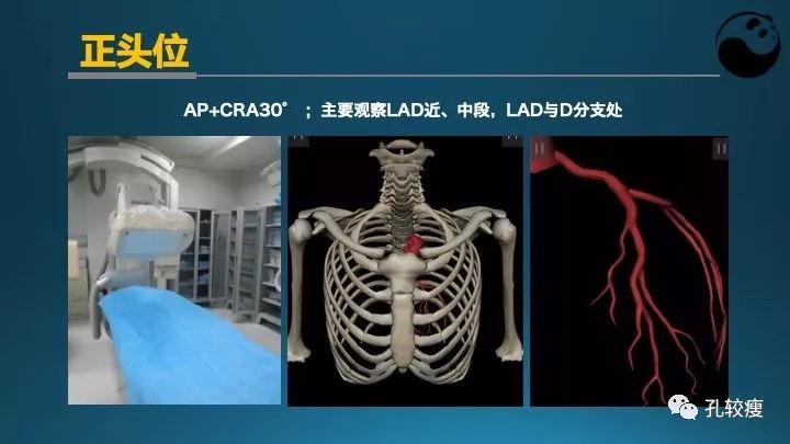 步步为营掌握冠状动脉造影:解剖-体位-安全法则