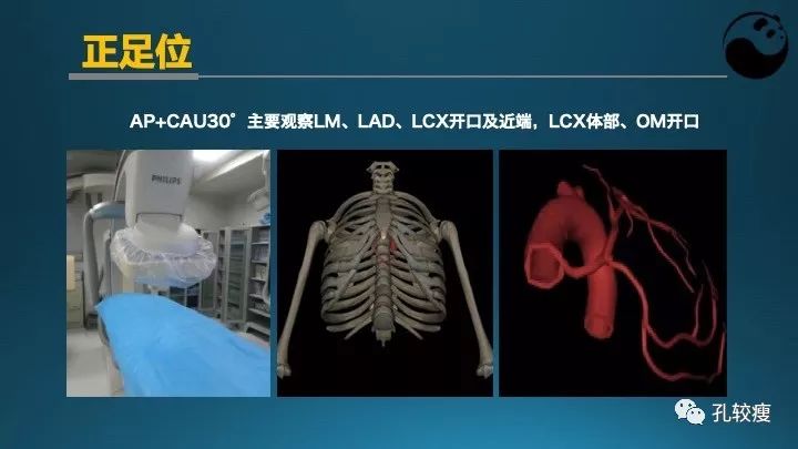 步步为营掌握冠状动脉造影:解剖-体位-安全法则