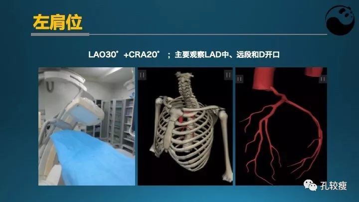 步步为营掌握冠状动脉造影:解剖-体位-安全法则