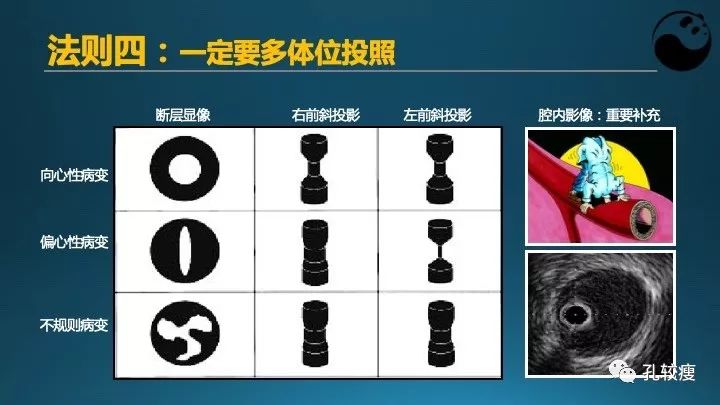 步步为营掌握冠状动脉造影:解剖-体位-安全法则