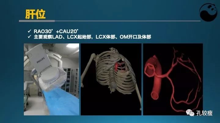 步步为营掌握冠状动脉造影:解剖-体位-安全法则