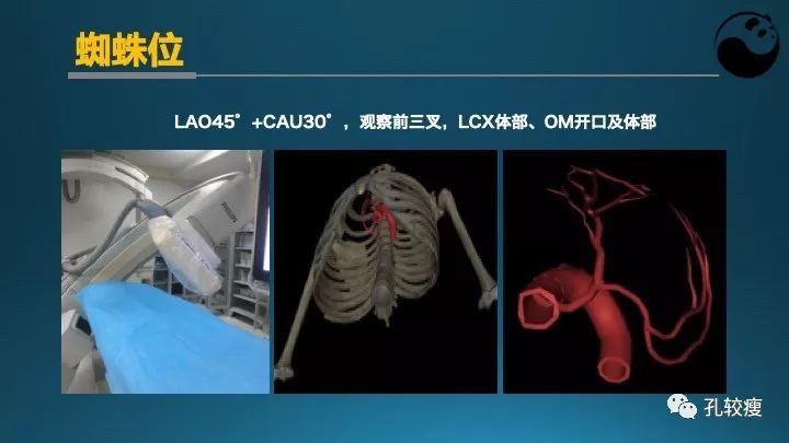 步步为营掌握冠状动脉造影:解剖-体位-安全法则