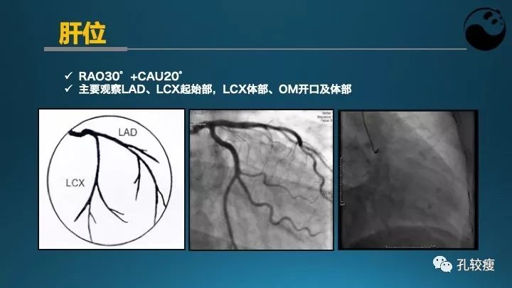 步步为营掌握冠状动脉造影:解剖-体位-安全法则
