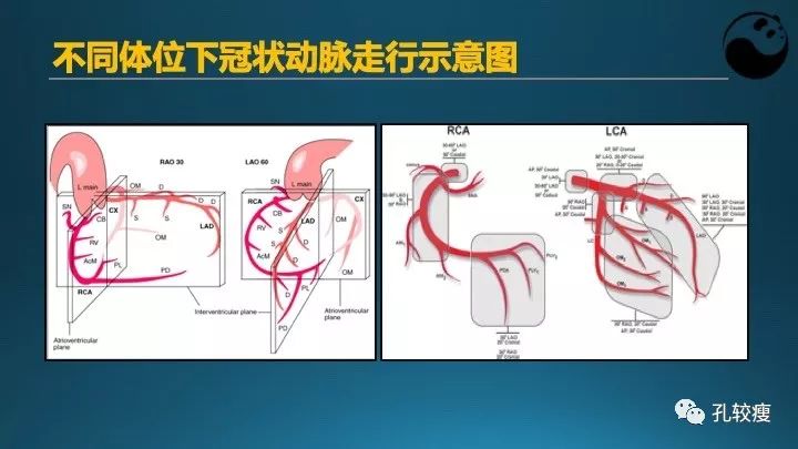步步为营掌握冠状动脉造影:解剖-体位-安全法则