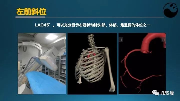 步步为营掌握冠状动脉造影:解剖-体位-安全法则