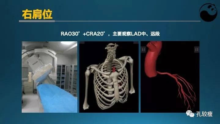 步步为营掌握冠状动脉造影:解剖-体位-安全法则