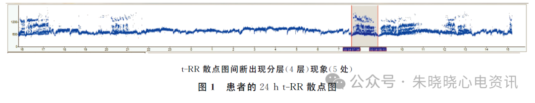 利用心电散点图特征诊断窦房传导阻滞
