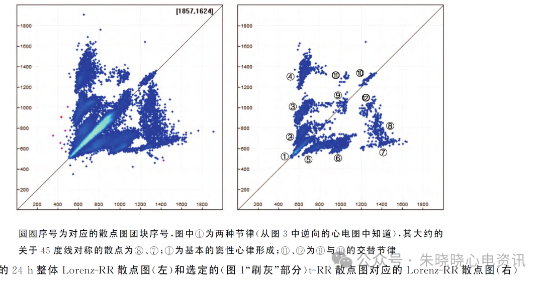 利用心电散点图特征诊断窦房传导阻滞