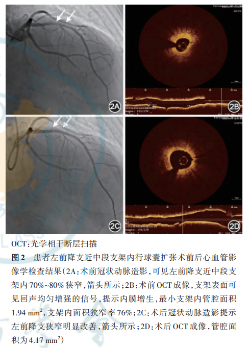 以间歇性跛行为表现的心绞痛