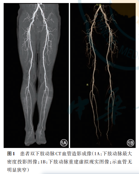 以间歇性跛行为表现的心绞痛