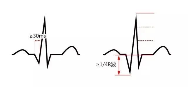 急性心梗心电图各阶段特点