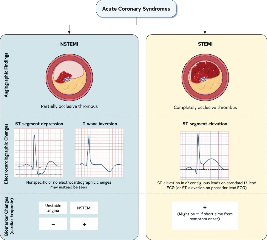 急性心梗诊疗：2025