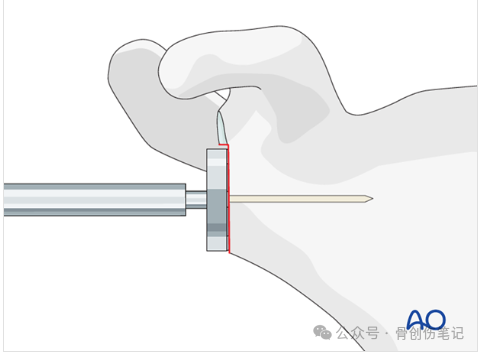 AO反肩关节置换术全流程拆解（附高清操作图解）